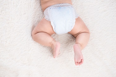 Birthmark on the leg of an Asian baby girl, who is wearing diapers while crawling.