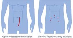 portrayal of incision sites for prostate robotic surgery