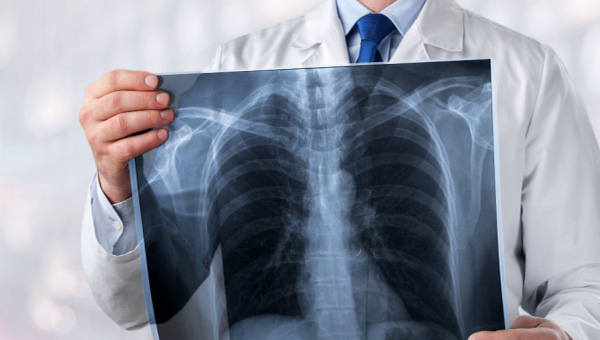 st josephs hospital lung cancer program