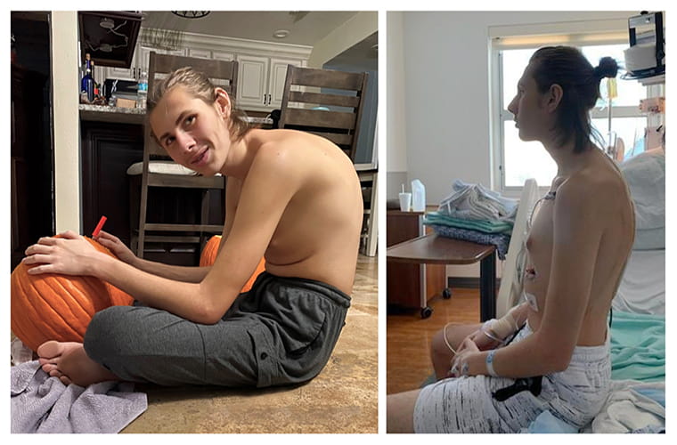 Spine Surgery Relieves Pain for St. Joseph’s Children’s Hospital Patient with Severe Case of the Spinal Disorder Kyphosis