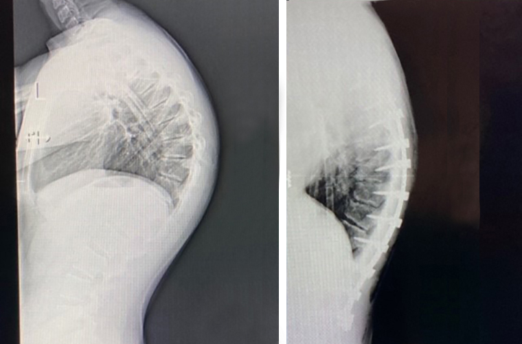 Spine Surgery Relieves Pain for St. Joseph’s Children’s Hospital Patient with Severe Case of the Spinal Disorder Kyphosis
