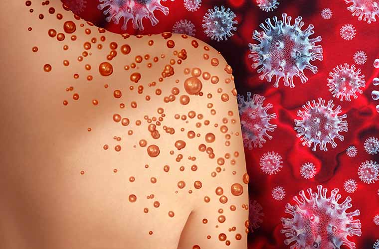 What you Need to Know about Monkeypox