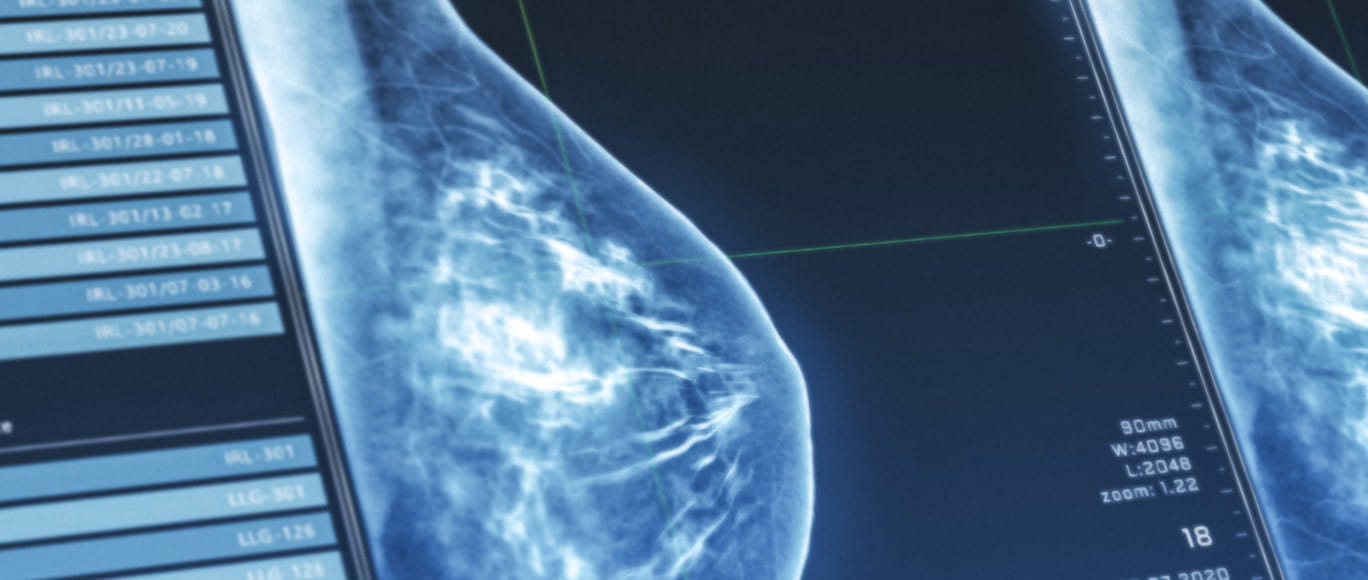 A computer screen in a radiology room shows an image of dense breast tissue on a mammography scan.