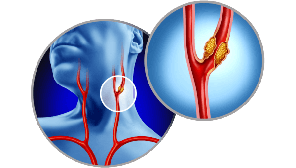 A diagram showing where the carotid artery is and a build up of plaque on the artery.
