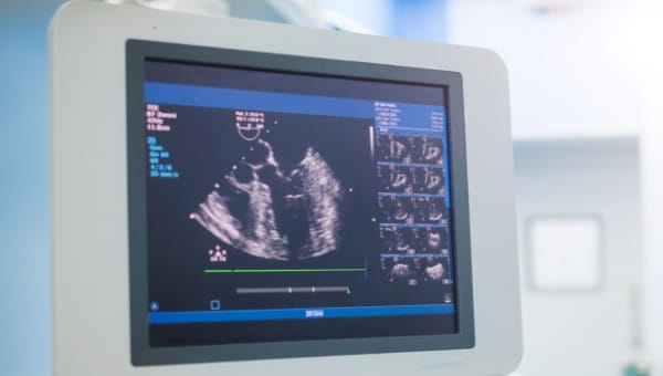 An ultrasound image on a monitor, illustrating diagnostic testing for heart and vascular conditions in clinical settings.