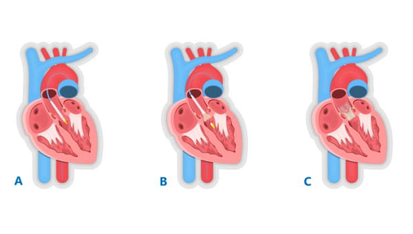 An illustration of a TAVR procedure's basic steps. 